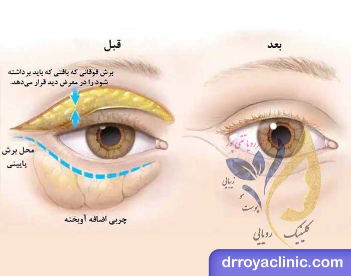 مدت زمان عمل بلفاروپلاستی