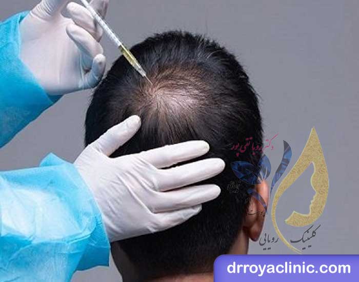 هزینه PRP مو جهت درمان ریزش مو در اصفهان