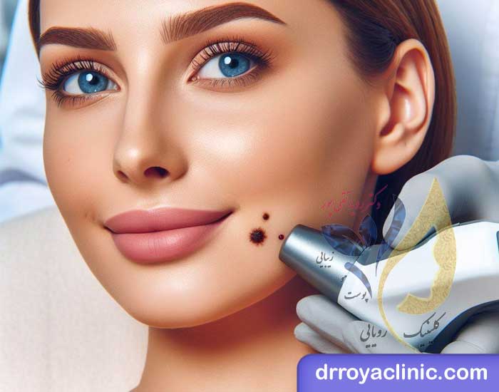 برداشتن خال در شاهین شهر