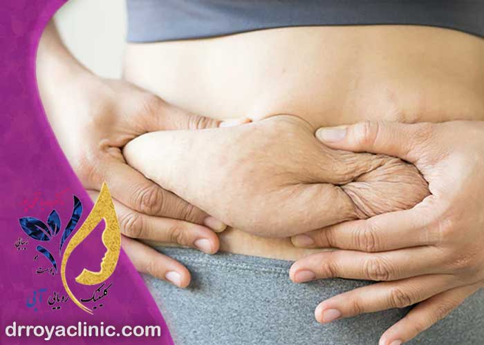 رفع افتادگی شکم بعد از زایمان در اصفهان