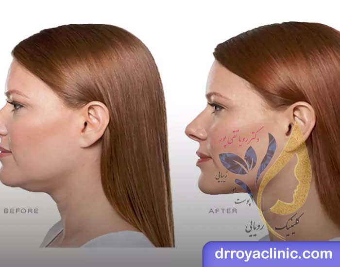 مزوتراپی چربی سوز برای چه افرادی مناسب می باشد؟