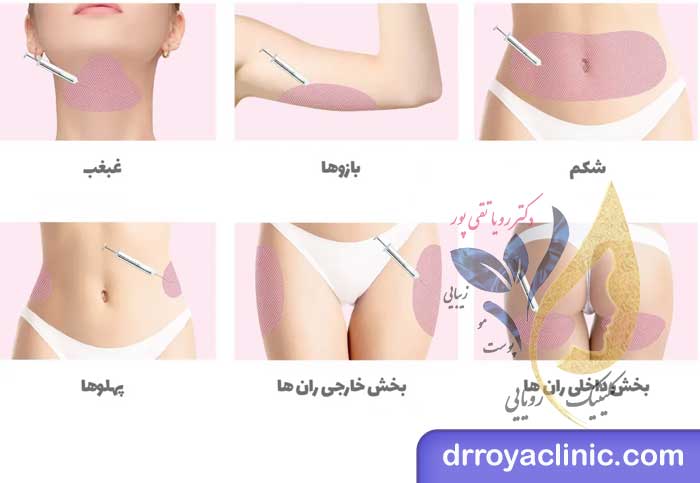 مراقبت های بعد از مزوتراپی چربی سوز