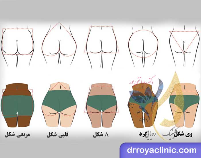 نظرات در مورد عمل پروتز سينه+سوتین طبی بعد از پروتزسینه+سوتین لیفت کننده چسبی+ماندگاری فیلر باسن+نظرات در مورد فیلر باسن