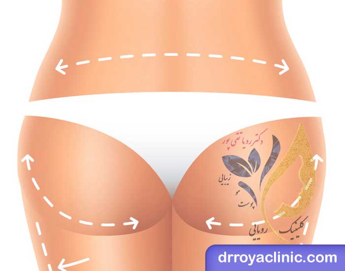 هزینه تزریق ژل باسن در اصفهان