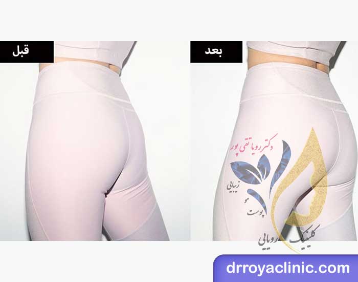 تزریق ژل باسن در اصفهان