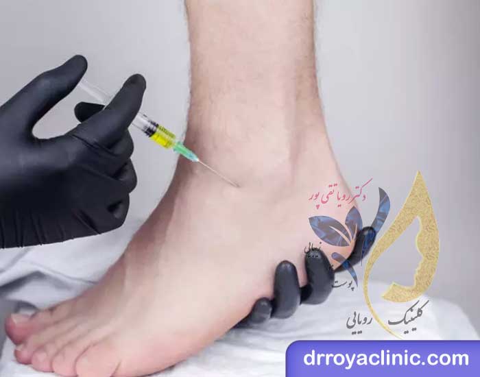 تزریق ژل به مچ پا در اصفهان