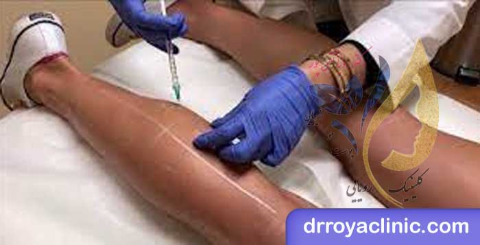 هزینه تزریق ژل به ساق و مچ پا در اصفهان