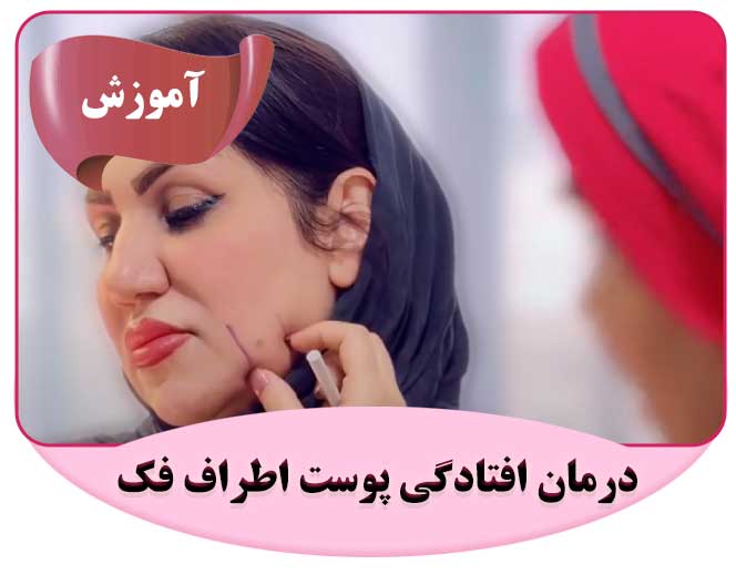 درمان افتادگی پوست اطراف فک