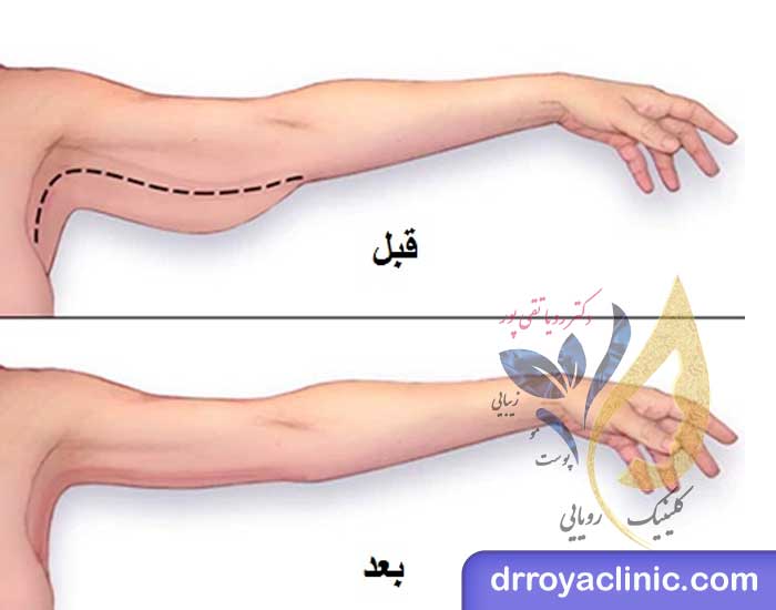 مزایای امبدینگ بازو