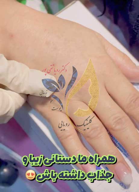 هزینه تزریق ژل به دست
