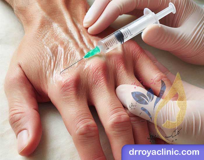 تزریق ژل و فیلر به دست چیست؟