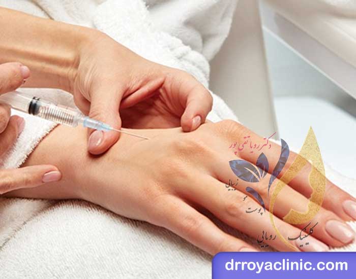 تزریق ژل به دست
