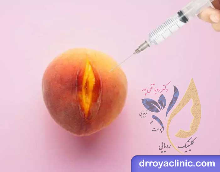 تزریق ژل به واژن