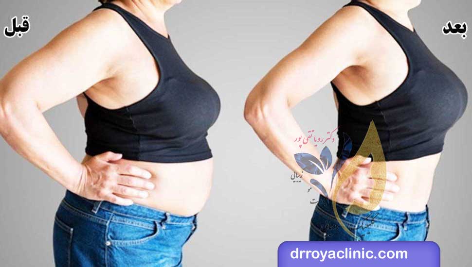 هزینه کاشت نخ لاغری برای شکم و پهلو