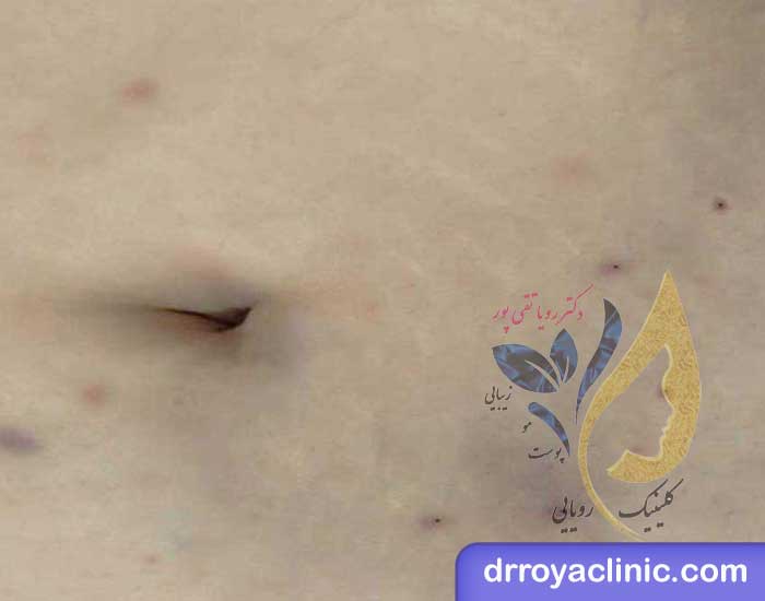 معایب امبدینگ شکم و پهلو