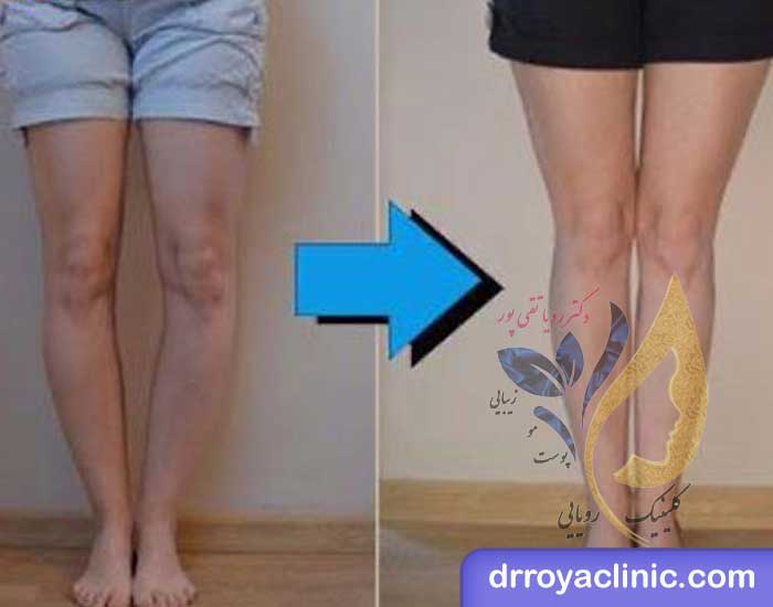 رفع مشکل پای پرانتزی با تزریق ژل