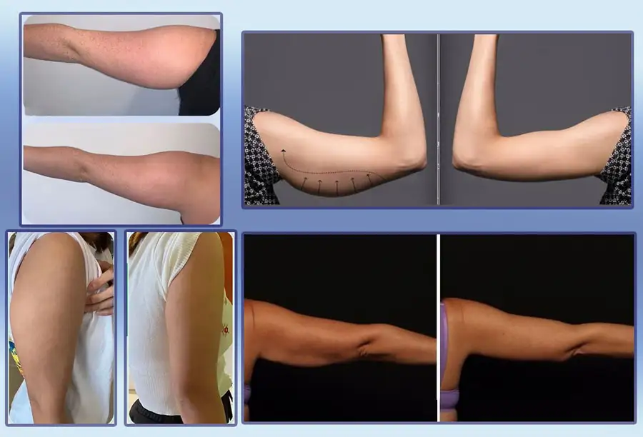 تصاویر قبل و بعد امبدینگ بازو