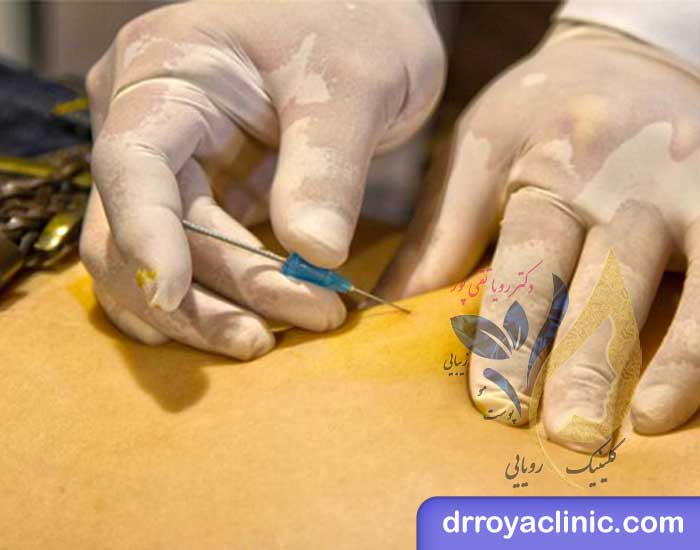 مراقبت ‌های بعد از امبدینگ در شاهین شهر