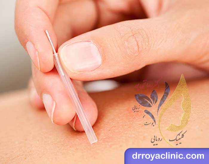 چه تفاوتی بین امبدینگ و طب سوزنی وجود دارد؟