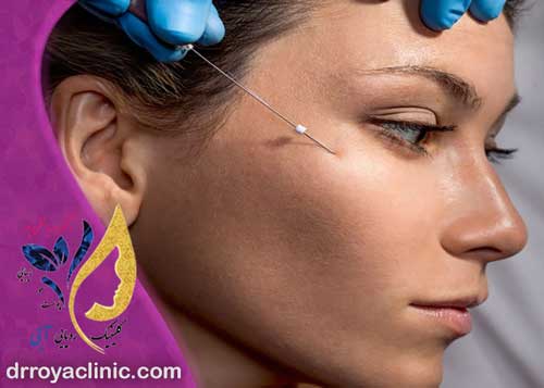 خطرات لیفت چشم گربه ‌ای در روش ‌های مختلف