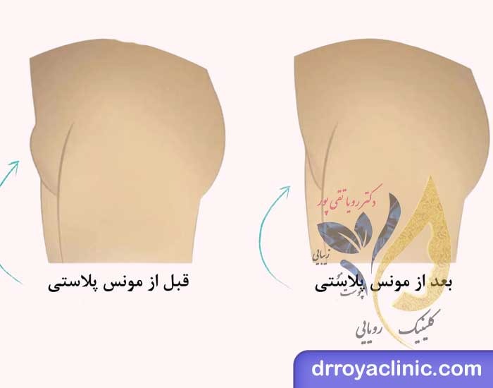 مونس پلاستی