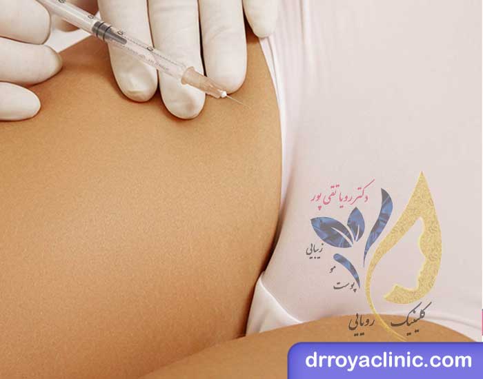 تزریق ژل و فیلر به واژن