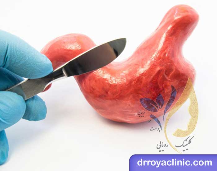 خطرات جراحی بای پس معده