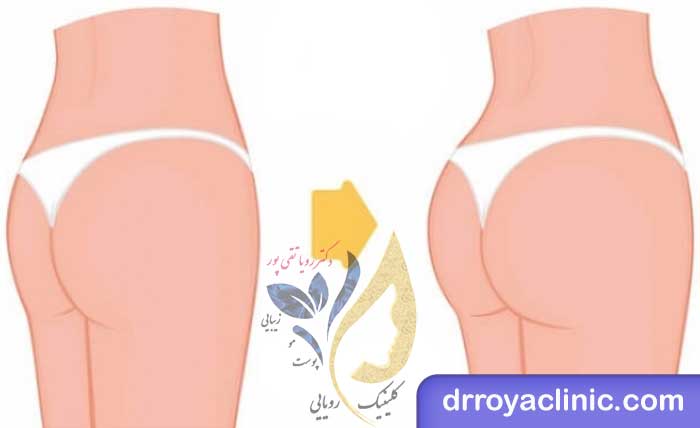 انواع ژل ‌‌های تزریقی برای بزرگ کردن باسن