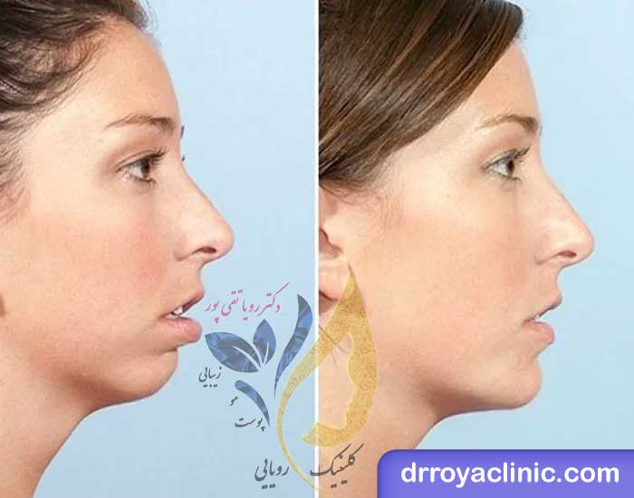 هزینه تزریق ژل چانه