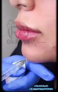فیلر چانه دکتر رویا تقی پور