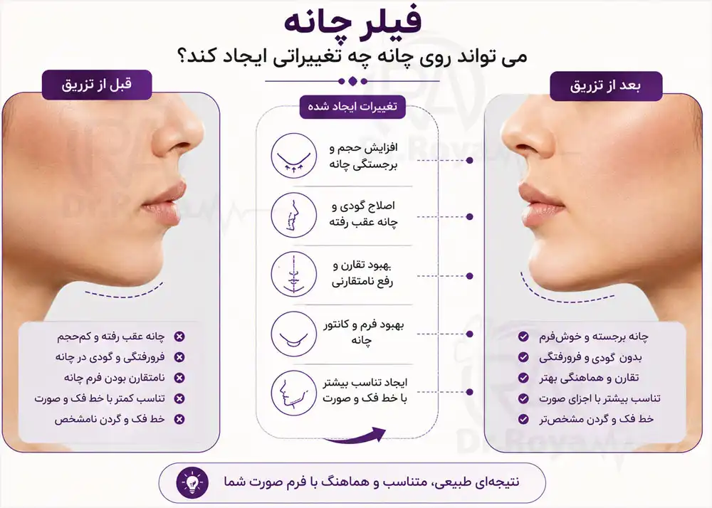 چه عیوبی هنگام تزریق ژل به چانه رفع می ‌شود؟