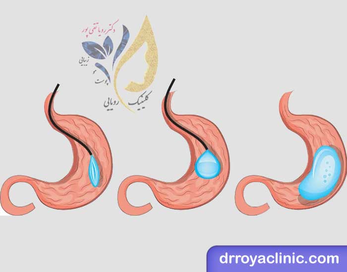 فرآیند قرار دادن بالن معده لاغری