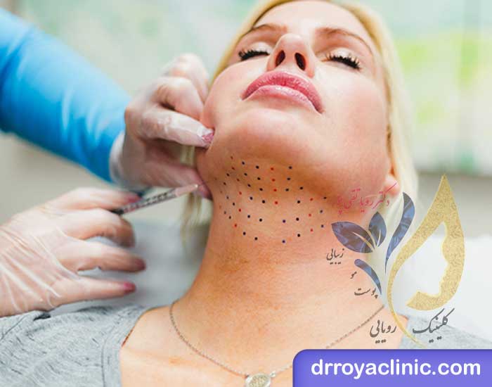 لاغر کردن صورت با مزوتراپی چربی سوز