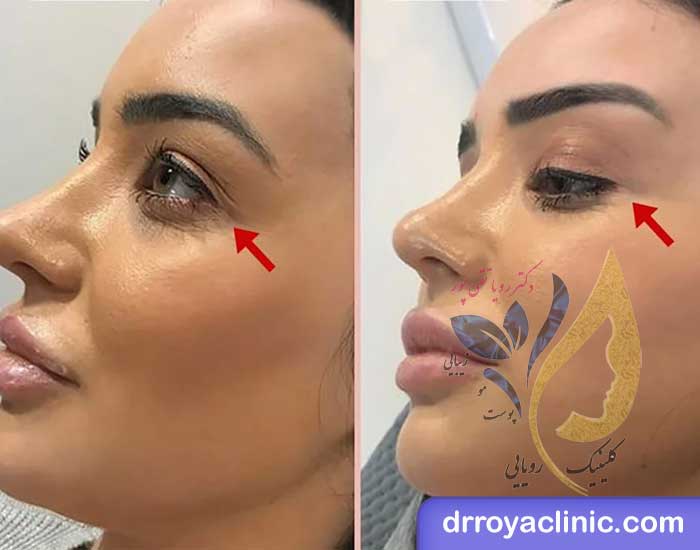 لیفت چشم با نخ