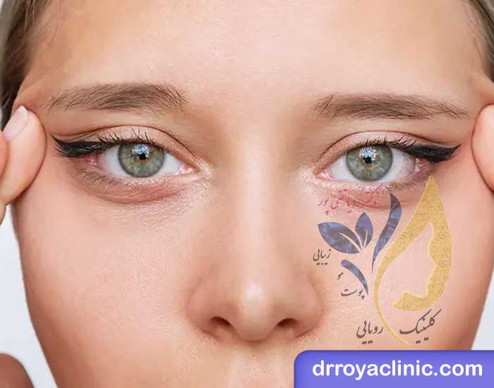 انواع روش های لیفت چشم