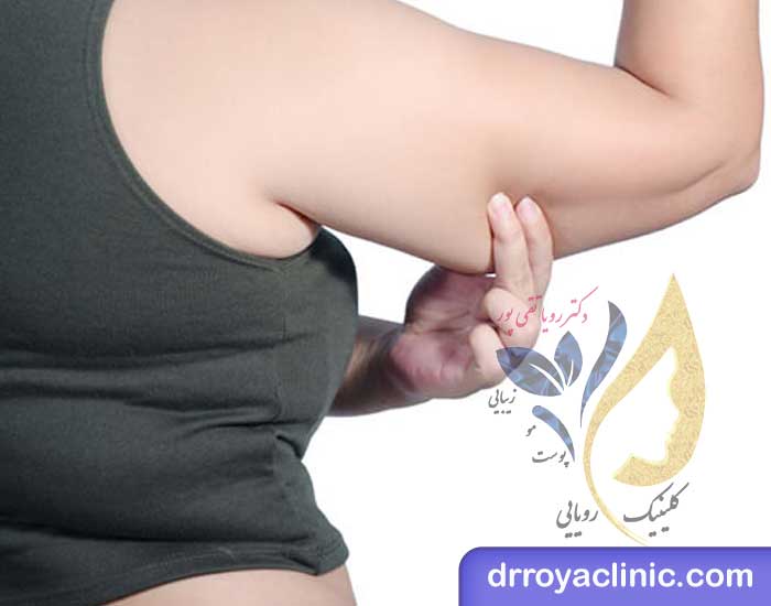 علت چاقی بازو‌ چیست؟