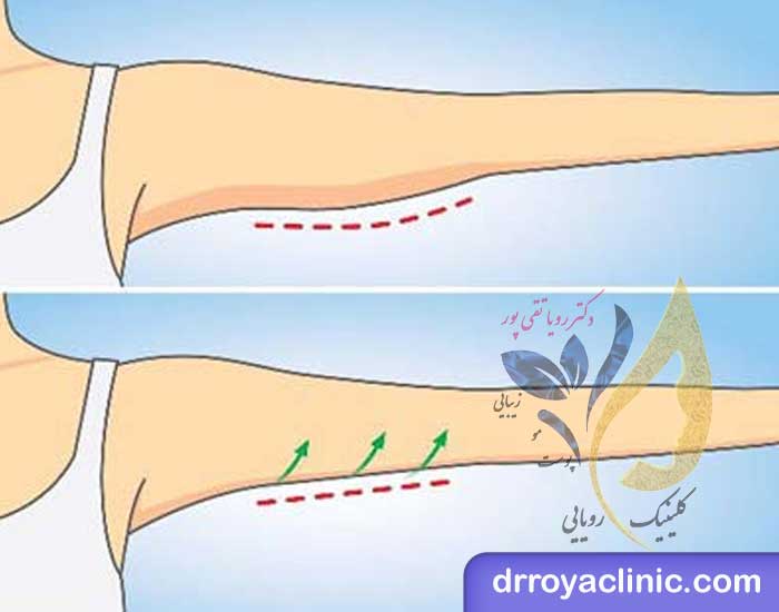 امبدینگ بازو