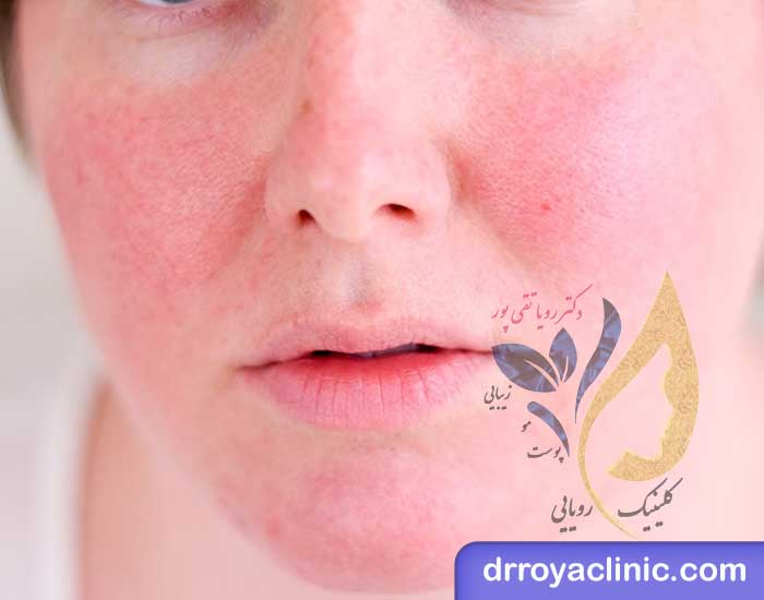 عوارض فیشیال صورت