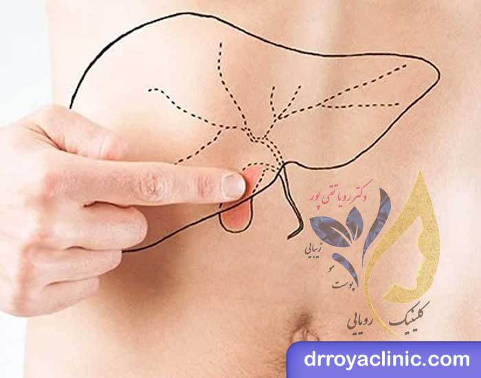 علت چاقی بعد از عمل کیسه صفرا
