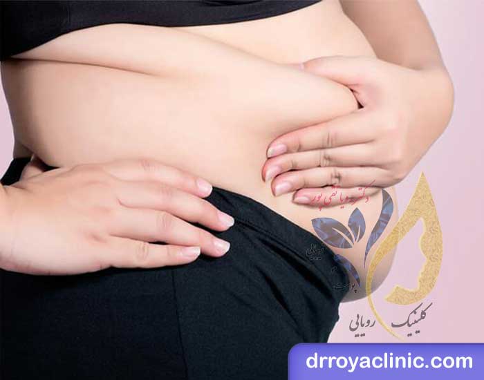 علت چاقی بعد از عمل کیسه صفرا چیست؟