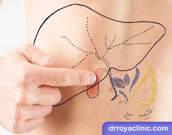 جراحی برداشتن کیسه صفرا