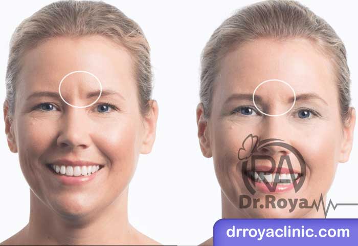 مزایای فیلر پیشانی