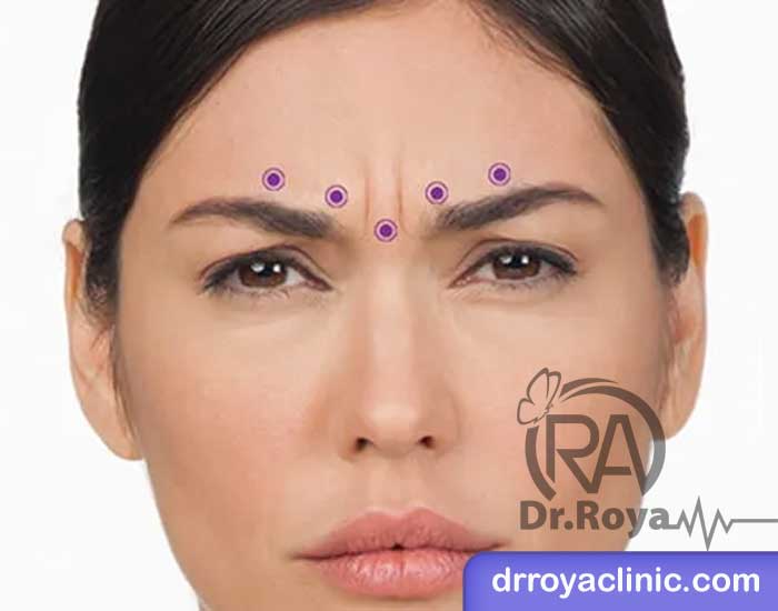 نحوه تزریق ژل به پیشانی