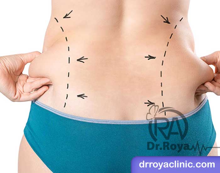 رایج ‌ترین روش ‌های لاغری موضعی