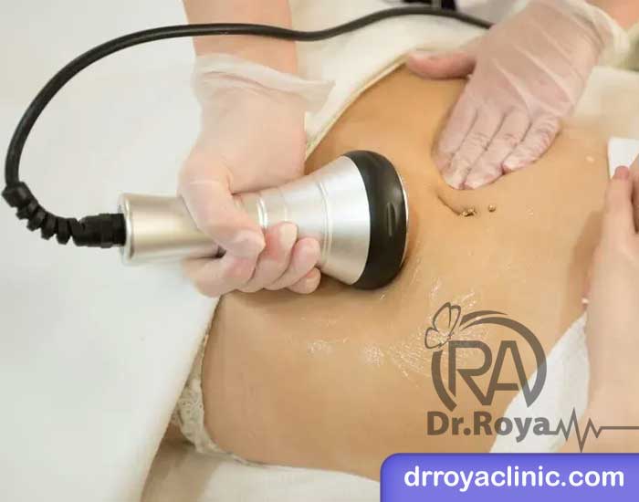 لاغری با دستگاه کویتیشن در شاهین شهر