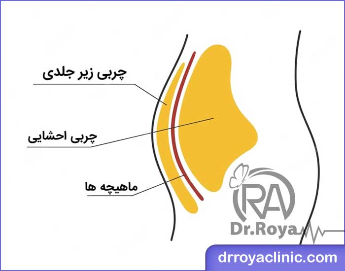 تفاوت چربی احشایی با چربی زیر جلدی چیست؟