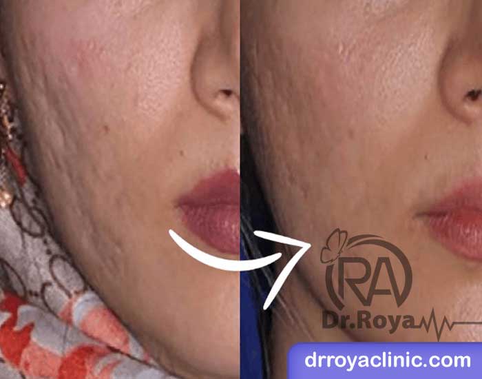 مدت ماندگاری نتایج حاصل از تزریق ژل به جای جوش