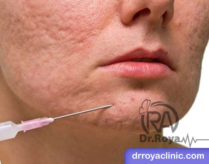 فرآیند انجام تزریق ژل الانسه برای جای جوش