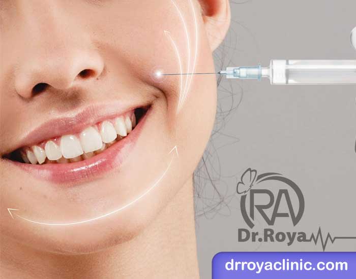 تزریق ژل خط خنده