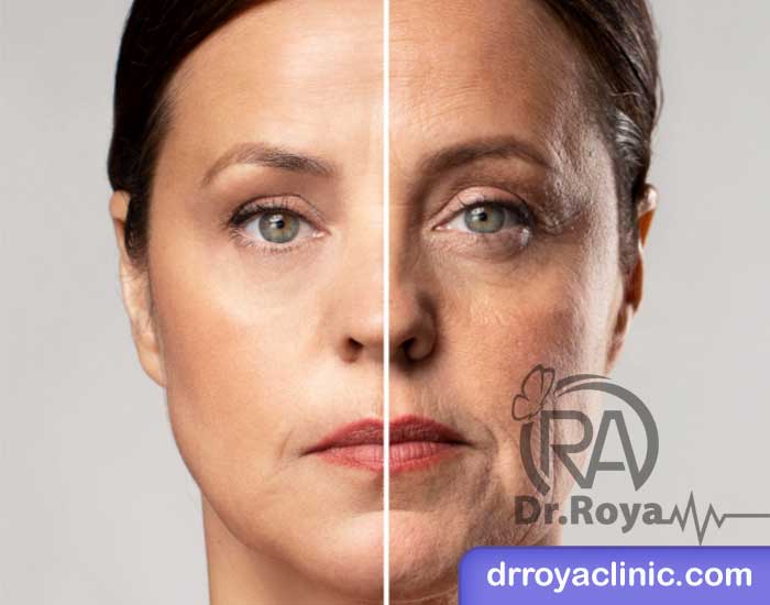 مزایای ژل پروفایلو